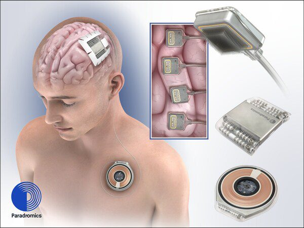Medical illustration of Paradromics Connexus Direct Data Interface: (from top right) Cortical modules record signals from 1600+ individual neurons; Cranial hub powers cortical modules and completes signal processing; Wireless transmitter (subcutaneous) provides power and secure, high-bandwidth data relay