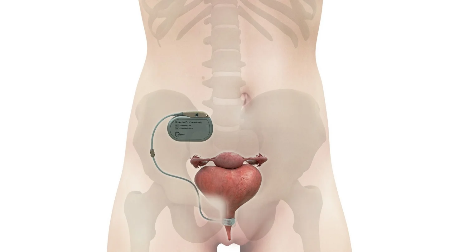 Diagram of UroActive device implanted in female patient.